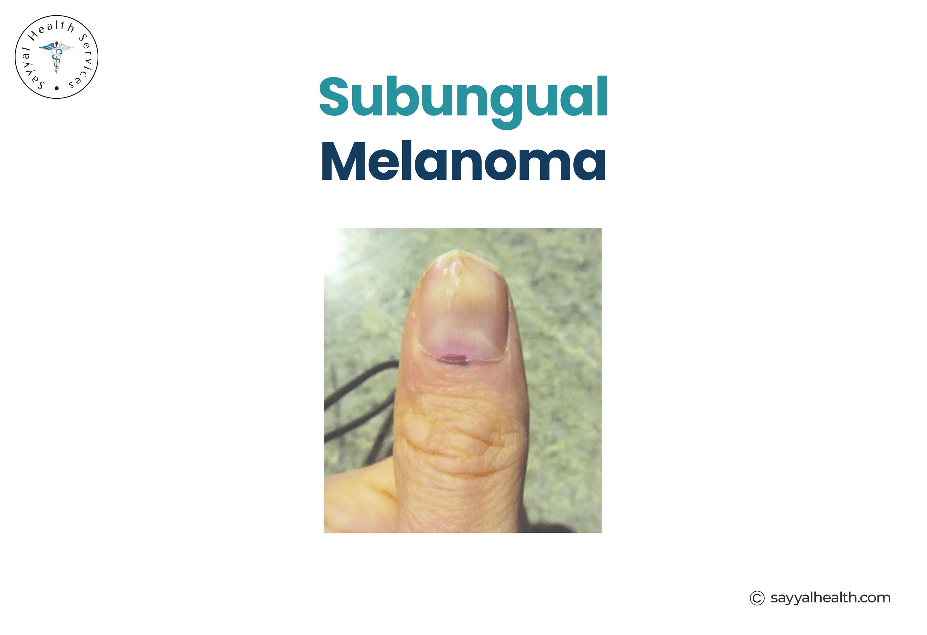 Subungual Melanoma Picture
